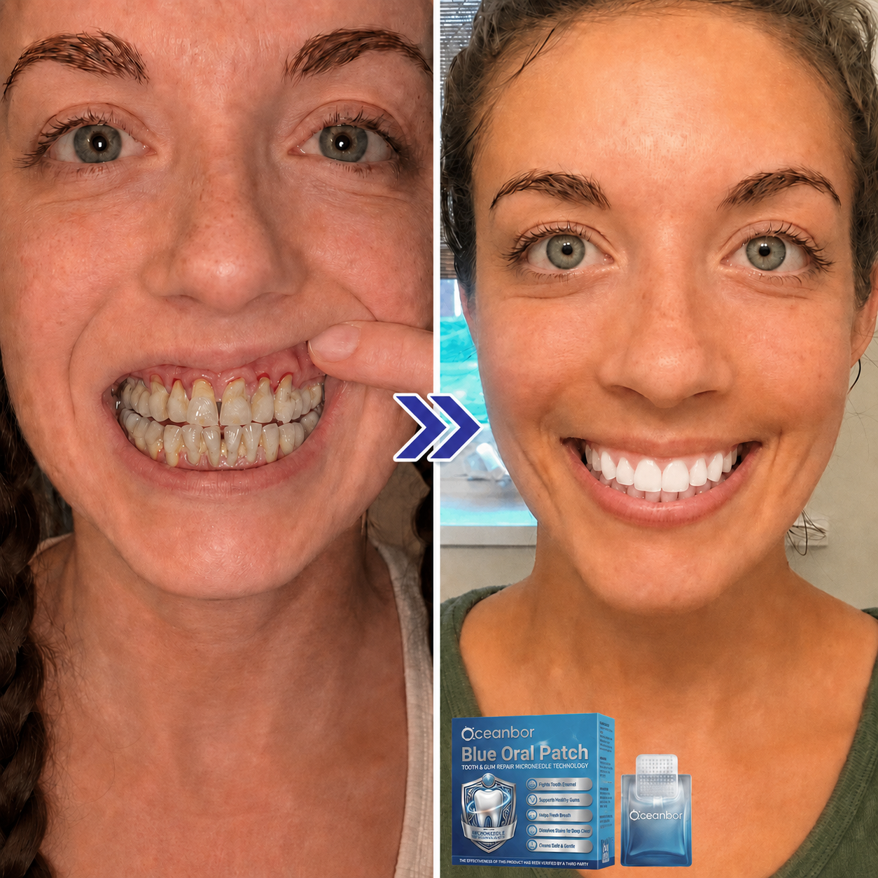 Ocearbor™ Blue Oral Patch | Tooth & Gum Repair